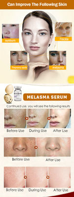 Μέση λεύκανση δερμάτων Melasma ορών φακίδων αφαίρεσης Microneedling ορών Skincare