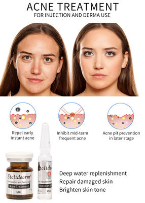 Ορός Mesotherapy εγχύσεων επεξεργασίας ακμής Stalidearm που δεν τρέφει καμία παρενέργεια